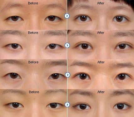 What is double eyelid surgery?